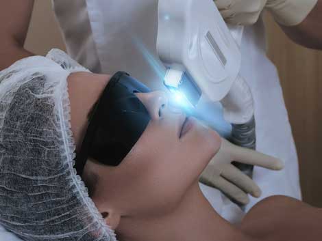 microneedling